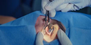 alternativas al microqueratomo en cirugia refractiva
