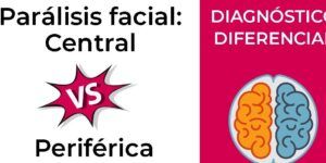 causa de paralisis facial y diagnostico