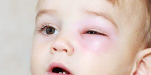 celulitis en el ojo y prevencion