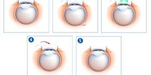 cirugia lasik y otros procedimientos
