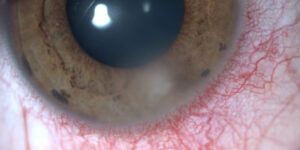 complicaciones oculares por uso lentes