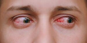 conjuntivitis y su periodo contagioso