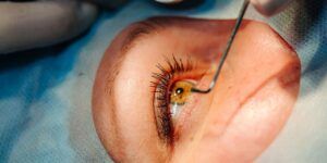 consejos preoperatorios para cirugia de cornea