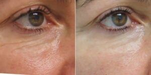 contornos de ojos rejuvenecedores