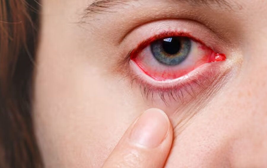 crema para picadura en ojo