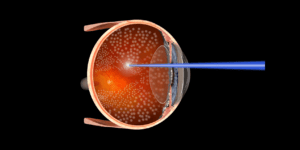 cuidados post fotocoagulacion laser de retina