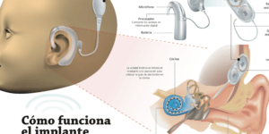 cuidados postoperatorios de implantes cocleares