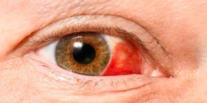 derrame en el ojo y tratamiento