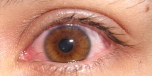 destellos de luz en los ojos