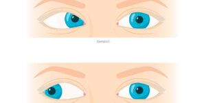 desviacion ocular y cirugia de estrabismo