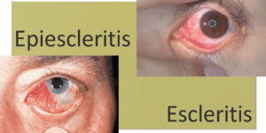 diferencia entre escleritis y epiescleritis