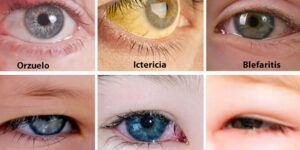 dolor de ojos en ninos