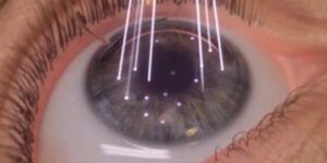 edad ideal para operarse los ojos