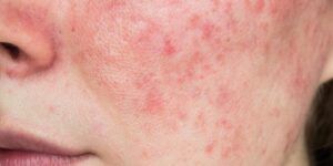 enrojecimiento facial al hacer ejercicio