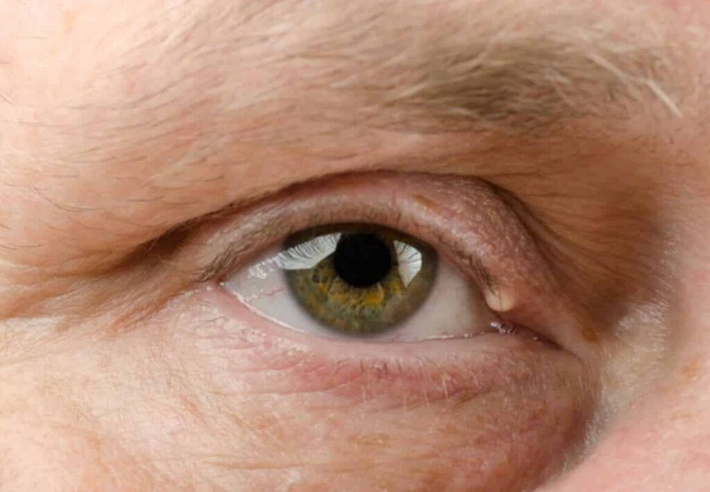 Grano blanco dentro del ojo: causas y síntomas de la pingueculitis