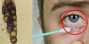 gusanos en los ojos sintomas tratamiento