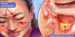 imagen de portada sinusitis e infeccion respiratoria