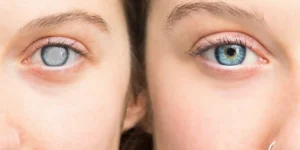 impacto del glaucoma en pacientes