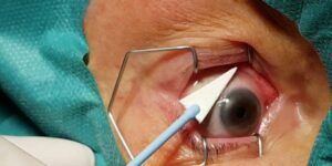 inyeccion en el ojo riesgos y beneficios