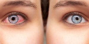 lentes de contacto para ojos sensibles