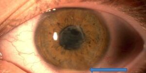 manifestacion ocular de la artritis