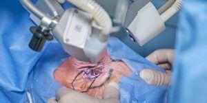 mito sobre operacion de cataratas