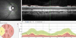 oct de glaucoma y deteccion
