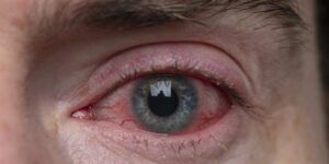 ojo con derrame y dolor
