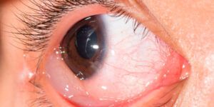ojo con la burbuja acuosa