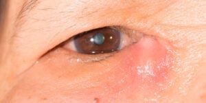 ojo con la dacriocistitis sintomas y tratamiento