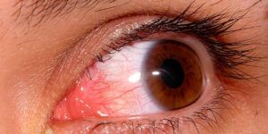 ojo rojo causas y remedios