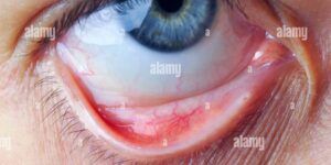 ojo y saco conjuntival