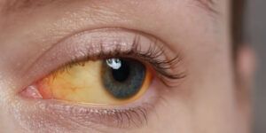 ojos amarillos causas y tratamientos