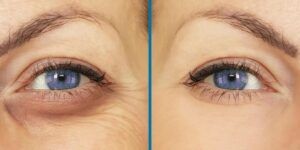 ojos hundidos antes y despues