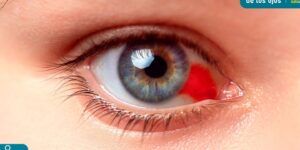 ojos rojos al despertar causas y tratamientos