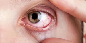 ojos secos causas y tratamientos