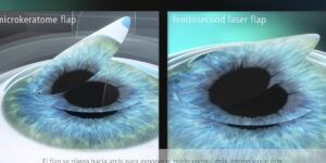 opciones de cirugia refractiva ocular