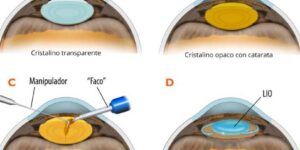 opciones de tratamiento para cataratas