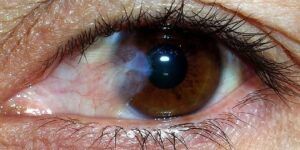 operacion de cataratas y prestaciones oculares