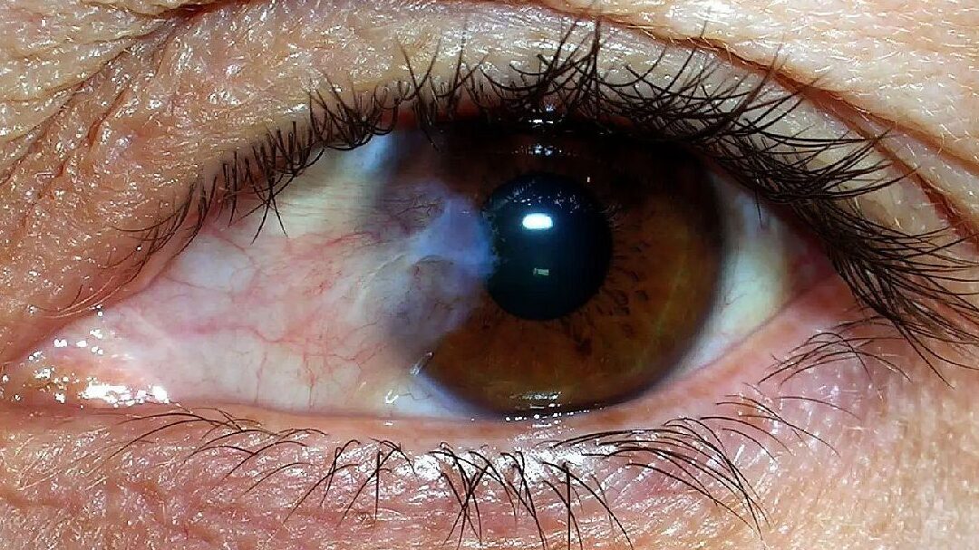 operacion de cataratas y prestaciones oculares