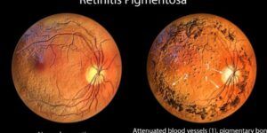persona con retinosis pigmentaria y sintomas
