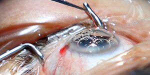 procedimiento de facoemulsificacion de catarata