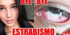 recuperacion de cirugia de estrabismo