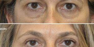 resultados de blefaroplastia antes despues