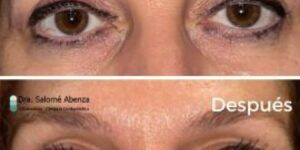 resultados de la ptosis palpebral antes y despues