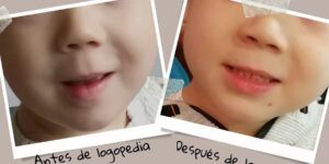 resultados de la terapia logopedica