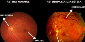 retinografia y tiempo de realizacion