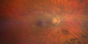 retinosis pigmentaria y esperanza de vida