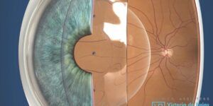 riesgos y complicaciones de cirugia icl