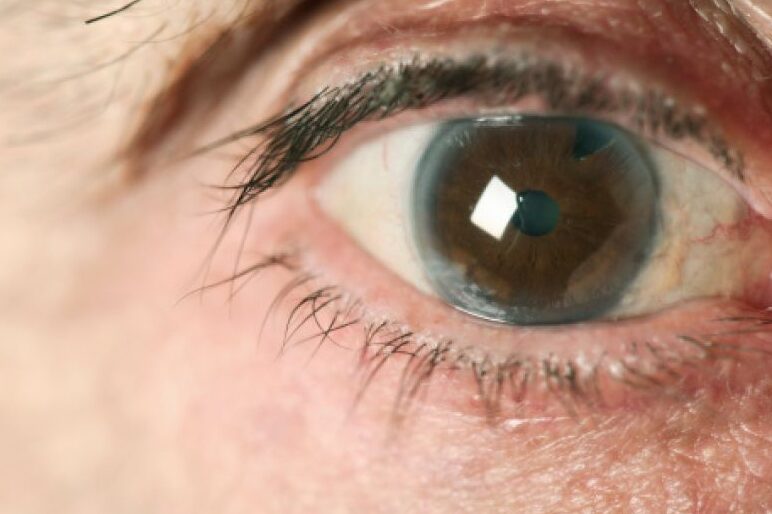 sintomas comunes del glaucoma